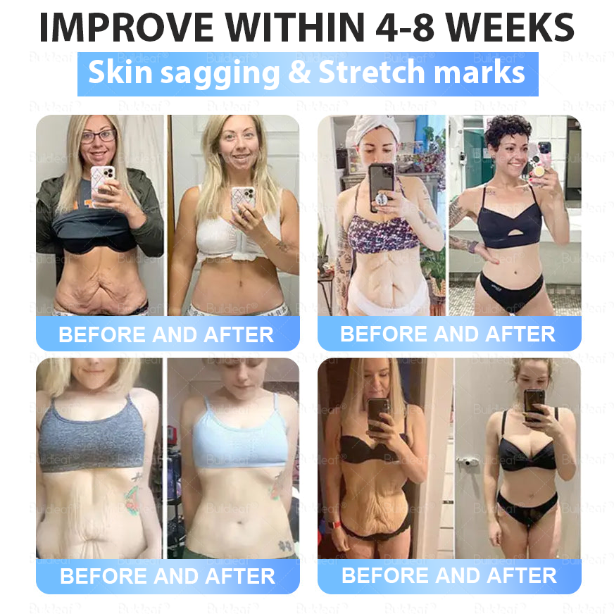 [Last Day Promotion 60% OFF] Buildleaf® Tirzepatide Slimming & Health Nano Microneedle Patch 🇺🇸👩‍⚕️(Zero Pain, 24/7 Release | Lose 20lbs FAST | 90%Sugar DropI)