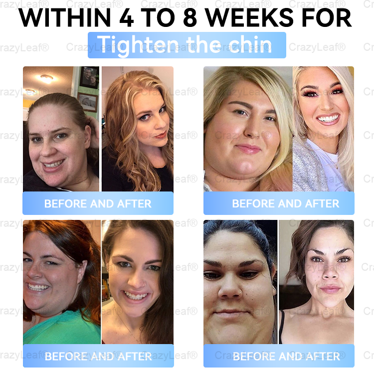 [Last Day Promotion 60% OFF] Buildleaf® Tirzepatide Slimming & Health Nano Microneedle Patch 🇺🇸👩‍⚕️(Zero Pain, 24/7 Release | Lose 20lbs FAST | 90%Sugar DropI)