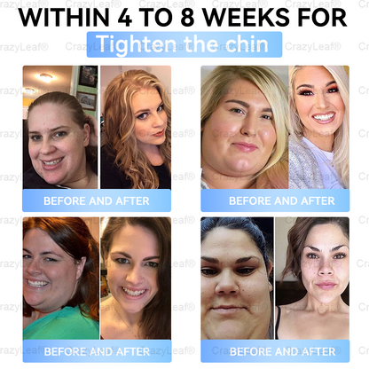 [Last Day Promotion 60% OFF] Buildleaf® Tirzepatide Slimming & Health Nano Microneedle Patch 🇺🇸👩‍⚕️(Zero Pain, 24/7 Release | Lose 20lbs FAST | 90%Sugar DropI)