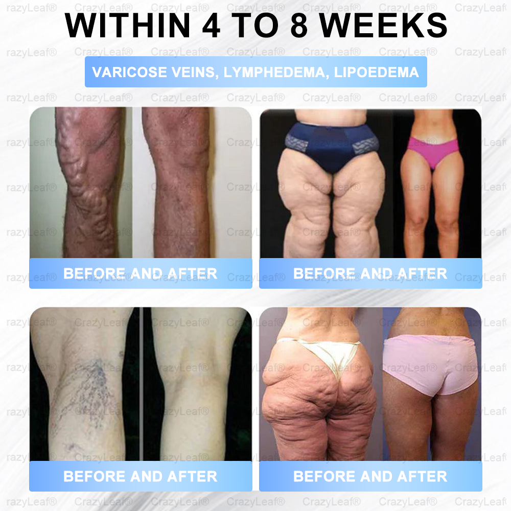 [Last Day Promotion 60% OFF] Buildleaf® Tirzepatide Slimming & Health Nano Microneedle Patch 🇺🇸👩‍⚕️(Zero Pain, 24/7 Release | Lose 20lbs FAST | 90%Sugar DropI)